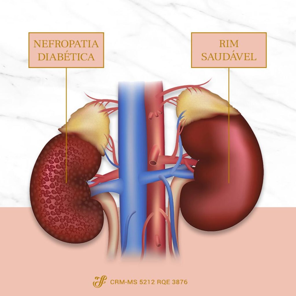nefroppatia diabética